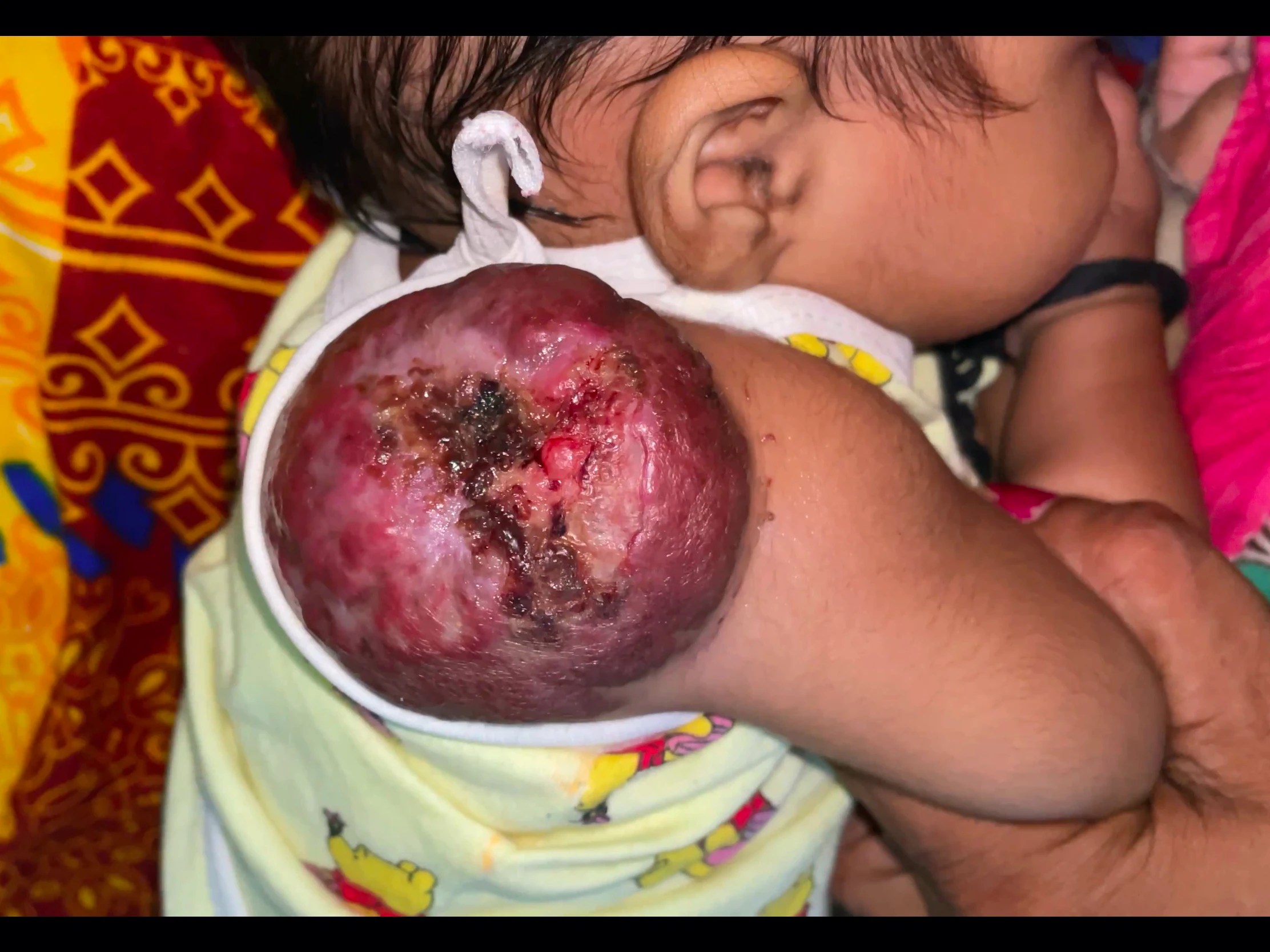 Massive hemangioma in right upper arm